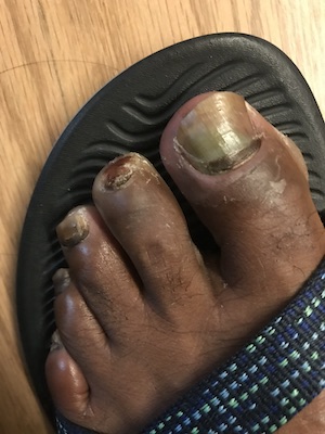 Pus-filled toes damaged by blisters.